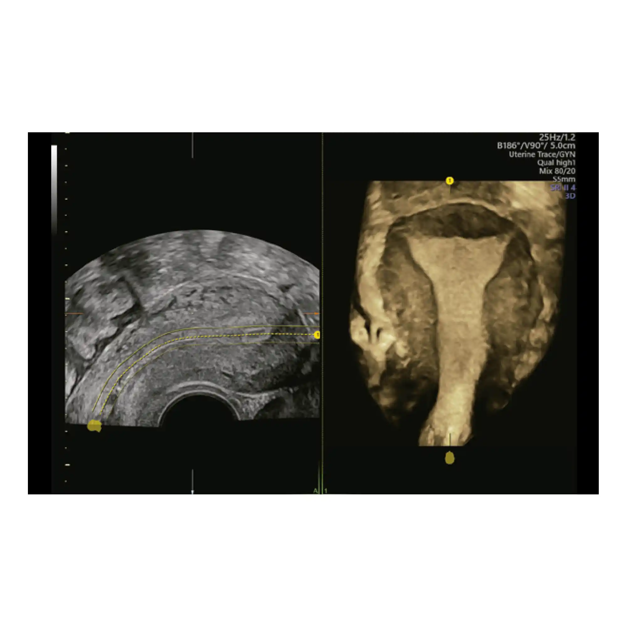 Uterine Trace