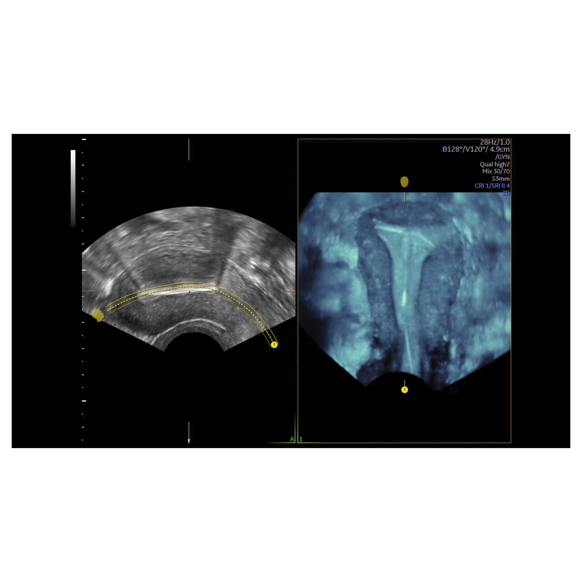 Uterine Trace